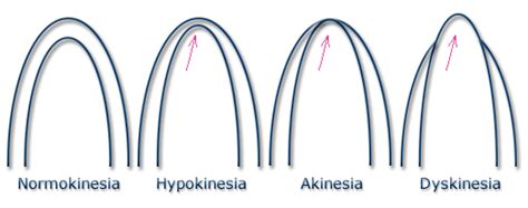 global hypokinesia of lv in hindi